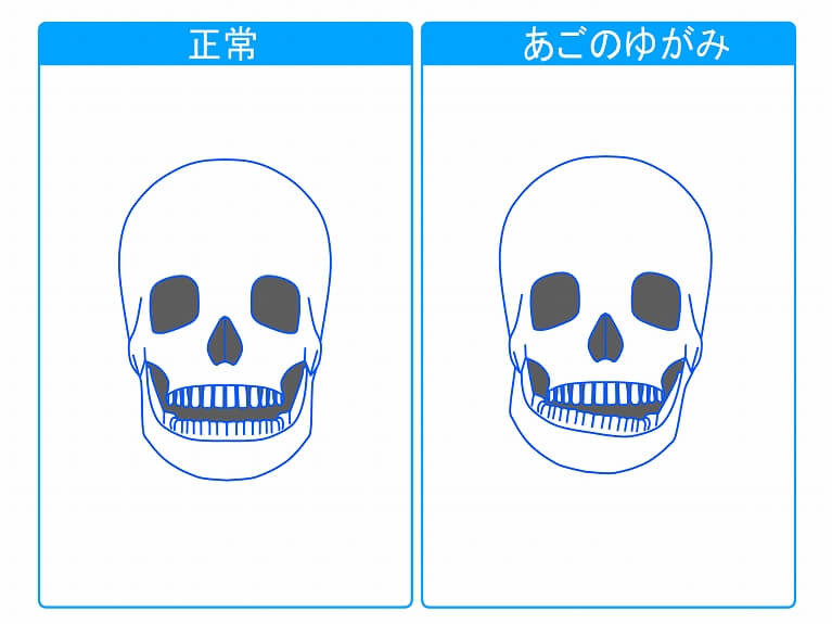 こんな方は顎関節症かもしれません