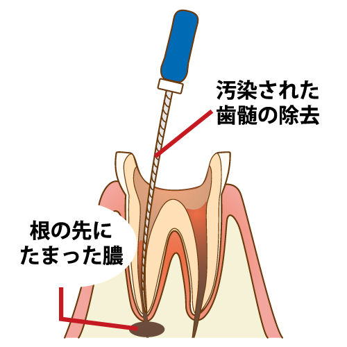 ニッケルチタンファイルの使用